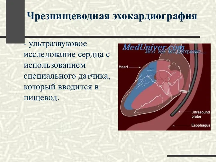 - ультразвуковое исследование сердца с использованием специального датчика, который вводится в пищевод. Чрезпищеводная эхокардиография