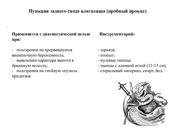 Пункция заднего свода влагалища (пробный прокол). Применяется с диагностической целью при: