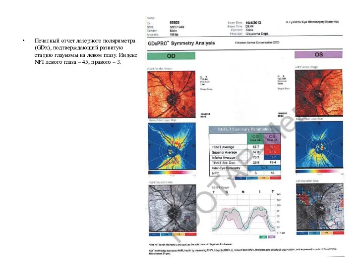 Печатный отчет лазерного поляриметра (GDx), подтверждающий развитую стадию глаукомы на левом