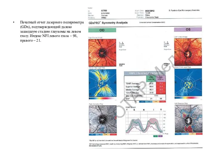 Печатный отчет лазерного поляриметра (GDx), подтверждающий далеко зашедшую стадию глаукомы на