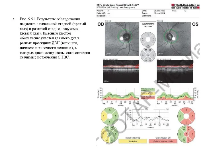 Рис. 5.51. Результаты обследования пациента с начальной стадией (правый глаз) и