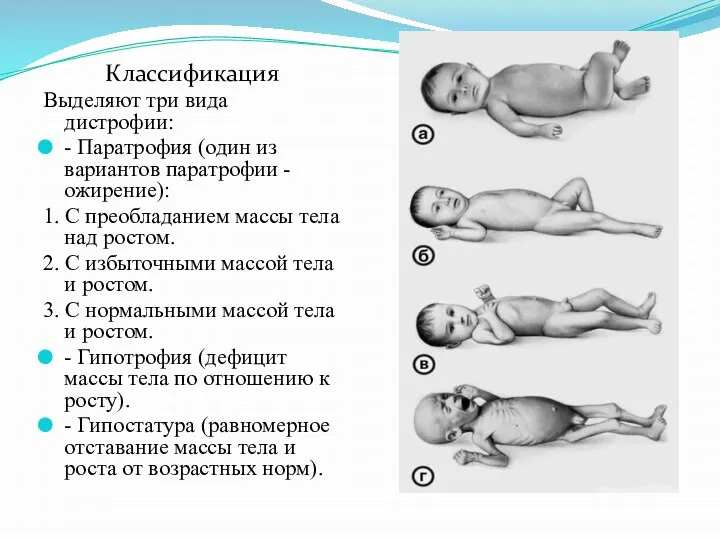 Классификация Выделяют три вида дистрофии: - Паратрофия (один из вариантов паратрофии