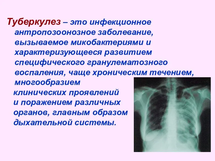 Туберкулез – это инфекционное антропозоонозное заболевание, вызываемое микобактериями и характеризующееся развитием