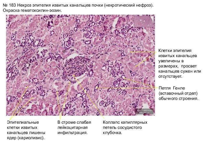 № 183 Некроз эпителия извитых канальцев почки (некротический нефроз). Окраска гематоксилин-эозин.