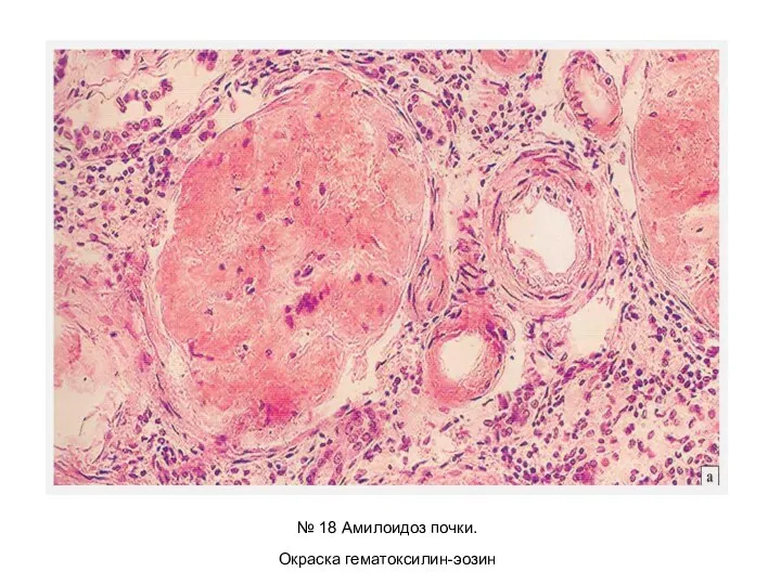 № 18 Амилоидоз почки. Окраска гематоксилин-эозин