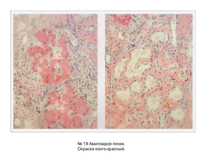 № 19 Амилоидоз почки. Окраска конго-красный.