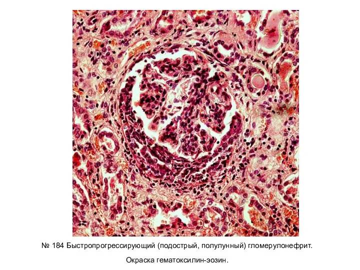 № 184 Быстропрогрессирующий (подострый, полулунный) гломерулонефрит. Окраска гематоксилин-эозин.
