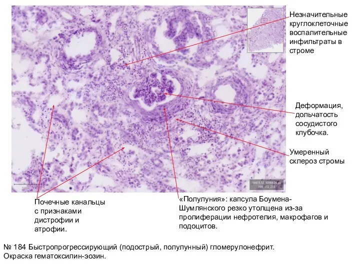 № 184 Быстропрогрессирующий (подострый, полулунный) гломерулонефрит. Окраска гематоксилин-эозин. Незначительные круглоклеточные воспалительные