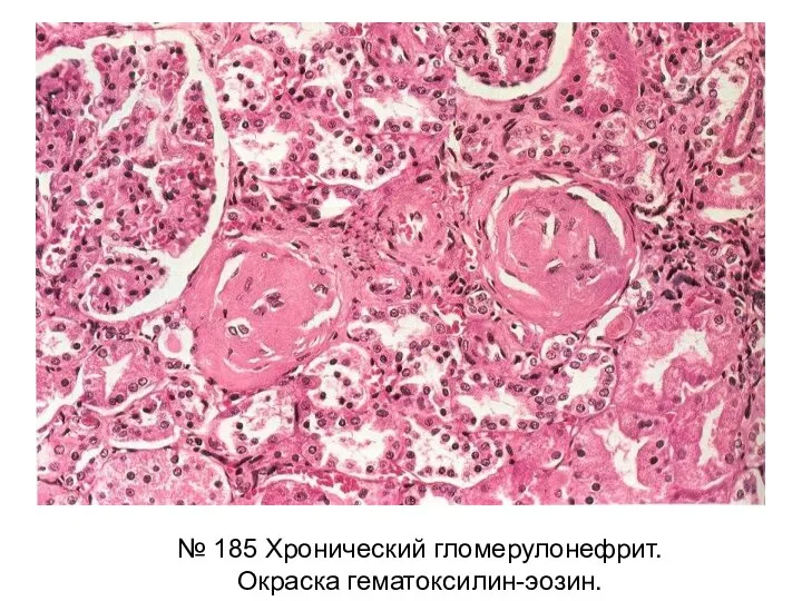 № 185 Хронический гломерулонефрит. Окраска гематоксилин-эозин.