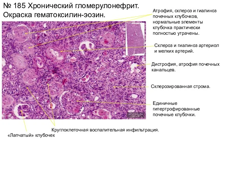 № 185 Хронический гломерулонефрит. Окраска гематоксилин-эозин. Круглоклеточная воспалительная инфильтрация. Атрофия, склероз