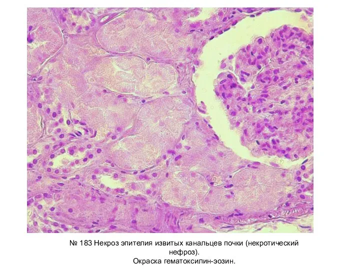 № 183 Некроз эпителия извитых канальцев почки (некротический нефроз). Окраска гематоксилин-эозин.