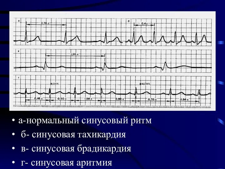 а-нормальный синусовый ритм б- синусовая тахикардия в- синусовая брадикардия г- синусовая аритмия