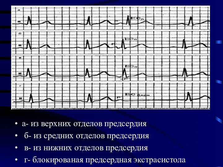 а- из верхних отделов предсердия б- из средних отделов предсердия в-