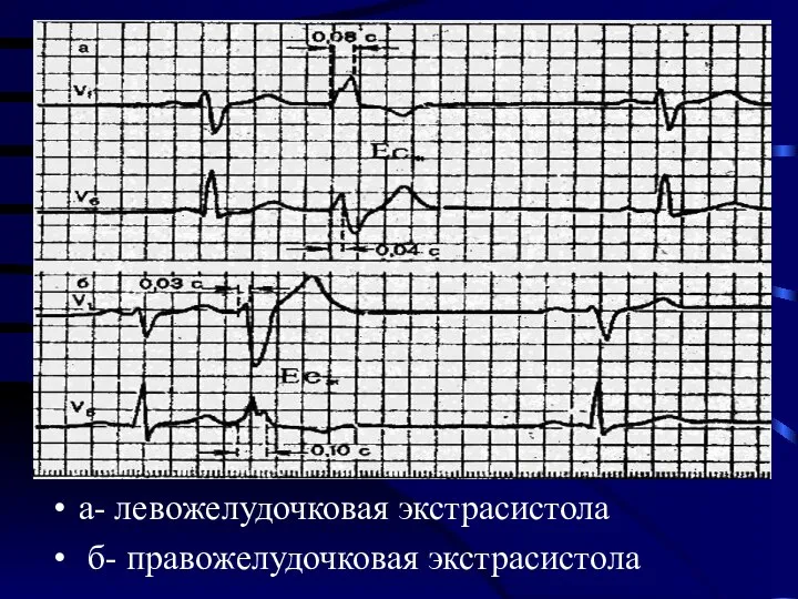 а- левожелудочковая экстрасистола б- правожелудочковая экстрасистола