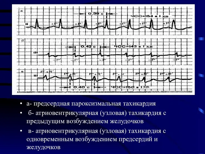 а- предсердная пароксизмальная тахикардия б- атриовентрикулярная (узловая) тахикардия с предыдущим возбуждением