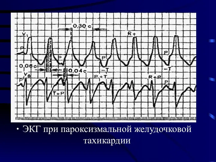 ЭКГ при пароксизмальной желудочковой тахикардии