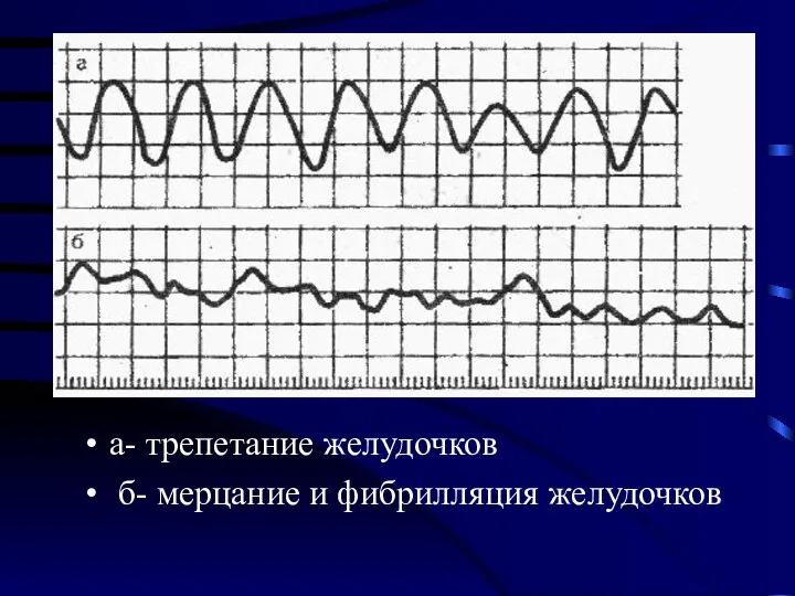 а- трепетание желудочков б- мерцание и фибрилляция желудочков