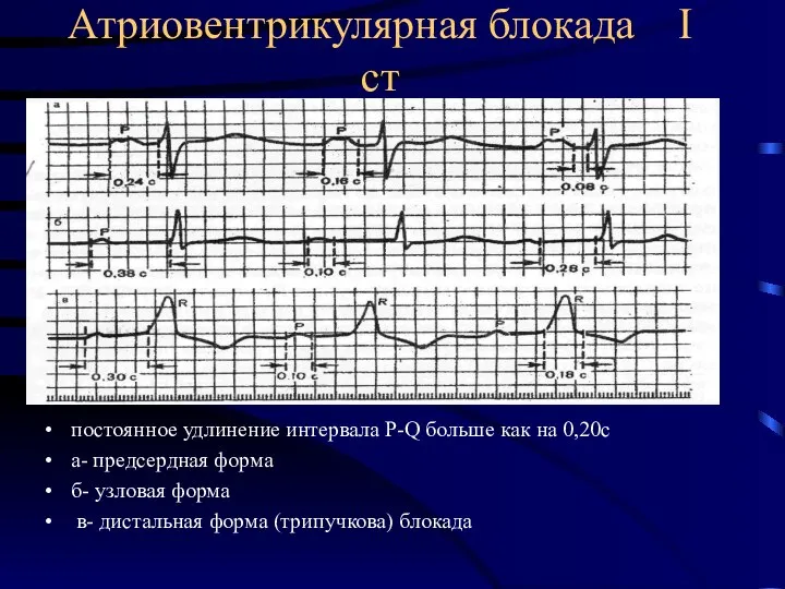 Атриовентрикулярная блокада I ст постоянное удлинение интервала P-Q больше как на