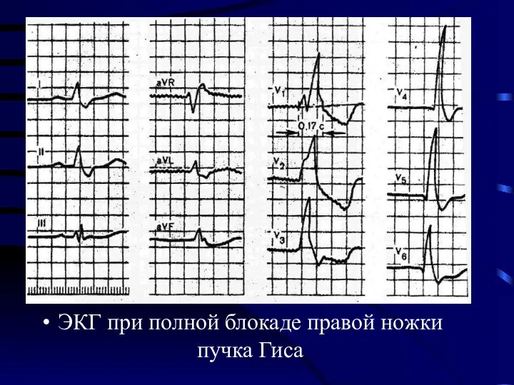 ЭКГ при полной блокаде правой ножки пучка Гиса