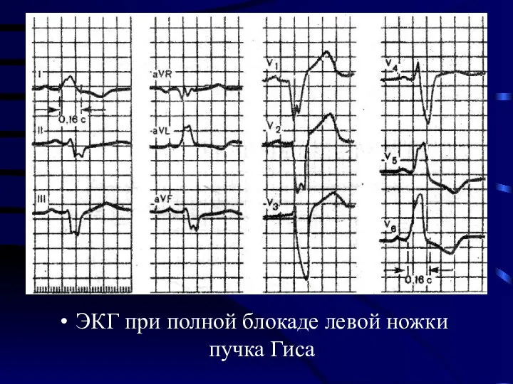 ЭКГ при полной блокаде левой ножки пучка Гиса