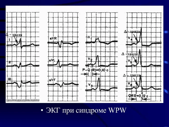 ЭКГ при синдроме WPW