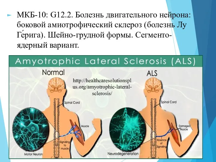 МКБ-10: G12.2. Болезнь двигательного нейрона: боковой амиотрофический склероз (болезнь Лу Ге́рига). Шейно-грудной формы. Cегменто-ядерный вариант. http://healthcaresolutionsplus.org/amyotrophic-lateral-sclerosis/