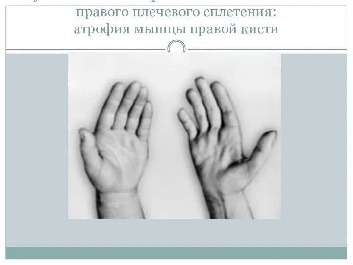 Руки больного с поражением нижнего ствола правого плечевого сплетения: атрофия мышцы правой кисти