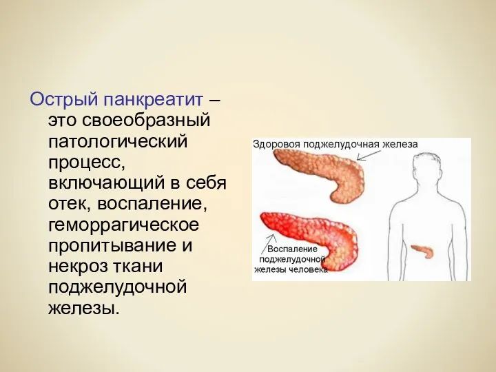 Острый панкреатит – это своеобразный патологический процесс, включающий в себя отек,