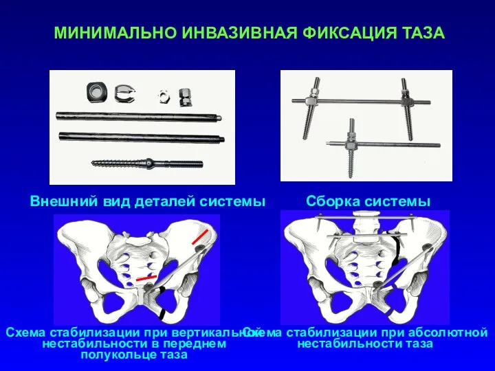 МИНИМАЛЬНО ИНВАЗИВНАЯ ФИКСАЦИЯ ТАЗА