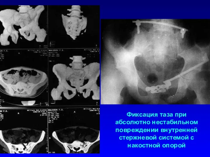 Фиксация таза при абсолютно нестабильном повреждении внутренней стержневой системой с накостной опорой