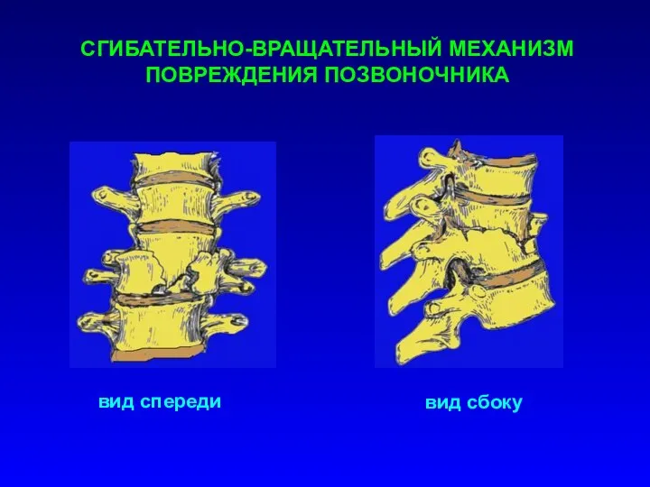 СГИБАТЕЛЬНО-ВРАЩАТЕЛЬНЫЙ МЕХАНИЗМ ПОВРЕЖДЕНИЯ ПОЗВОНОЧНИКА вид спереди вид сбоку