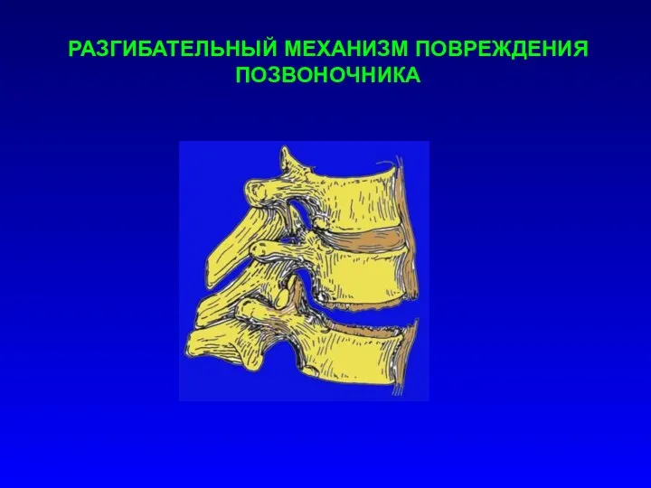 РАЗГИБАТЕЛЬНЫЙ МЕХАНИЗМ ПОВРЕЖДЕНИЯ ПОЗВОНОЧНИКА