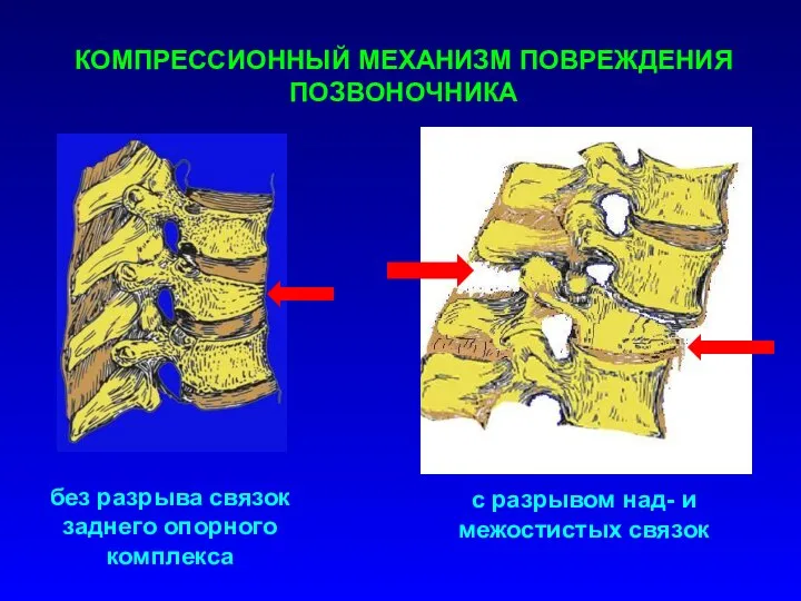 КОМПРЕССИОННЫЙ МЕХАНИЗМ ПОВРЕЖДЕНИЯ ПОЗВОНОЧНИКА без разрыва связок заднего опорного комплекса с разрывом над- и межостистых связок