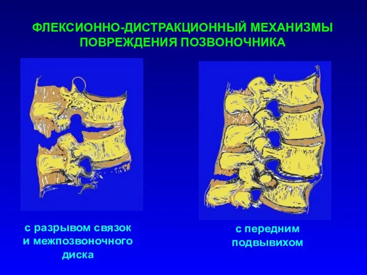 ФЛЕКСИОННО-ДИСТРАКЦИОННЫЙ МЕХАНИЗМЫ ПОВРЕЖДЕНИЯ ПОЗВОНОЧНИКА с разрывом связок и межпозвоночного диска с передним подвывихом