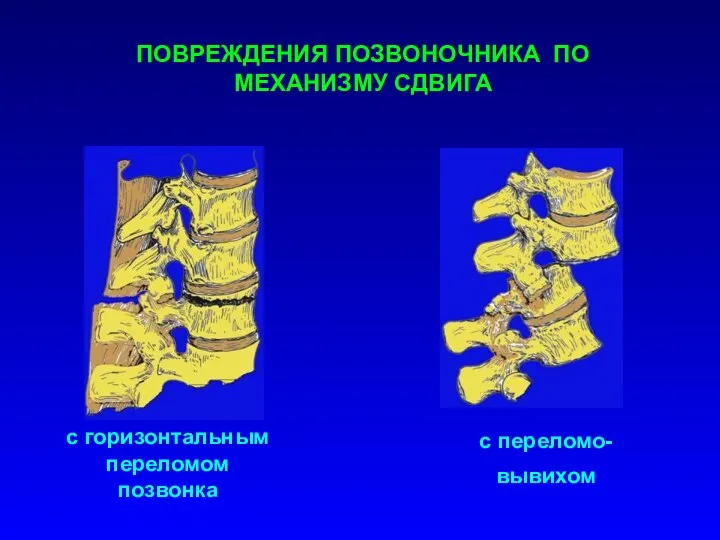 ПОВРЕЖДЕНИЯ ПОЗВОНОЧНИКА ПО МЕХАНИЗМУ СДВИГА с горизонтальным переломом позвонка с переломо- вывихом