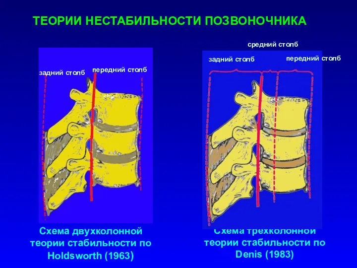 ТЕОРИИ НЕСТАБИЛЬНОСТИ ПОЗВОНОЧНИКА Схема двухколонной теории стабильности по Holdsworth (1963) Схема