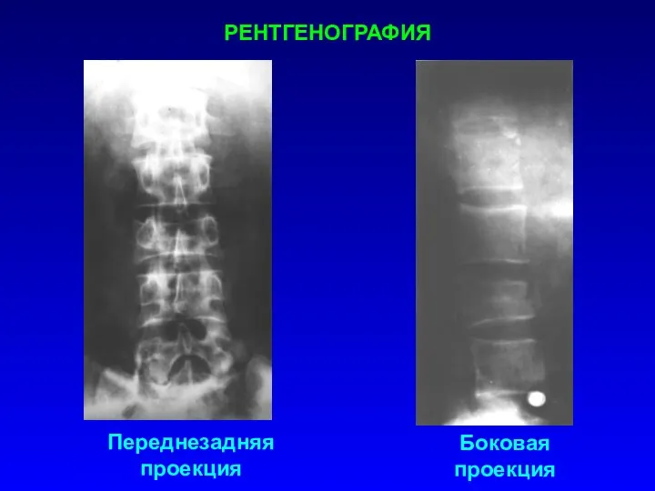 РЕНТГЕНОГРАФИЯ Переднезадняя проекция Боковая проекция