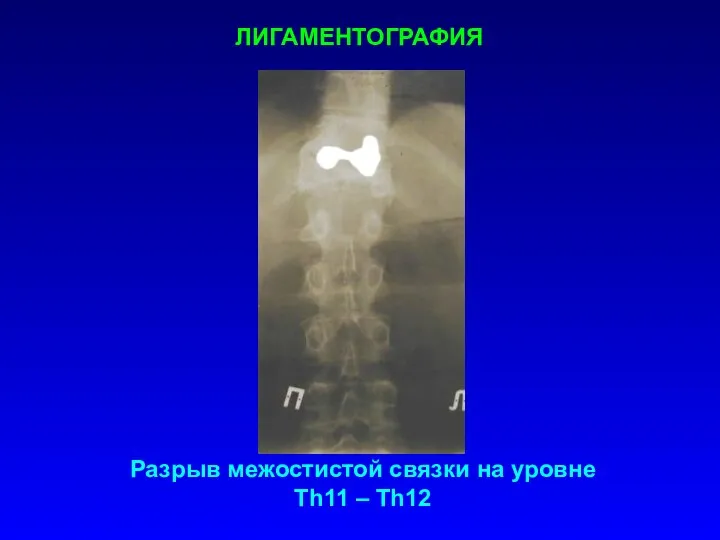 ЛИГАМЕНТОГРАФИЯ Разрыв межостистой связки на уровне Th11 – Th12