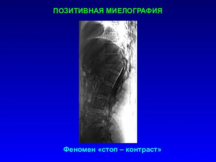 ПОЗИТИВНАЯ МИЕЛОГРАФИЯ Феномен «стоп – контраст»