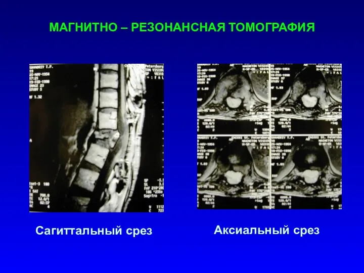 МАГНИТНО – РЕЗОНАНСНАЯ ТОМОГРАФИЯ Сагиттальный срез Аксиальный срез