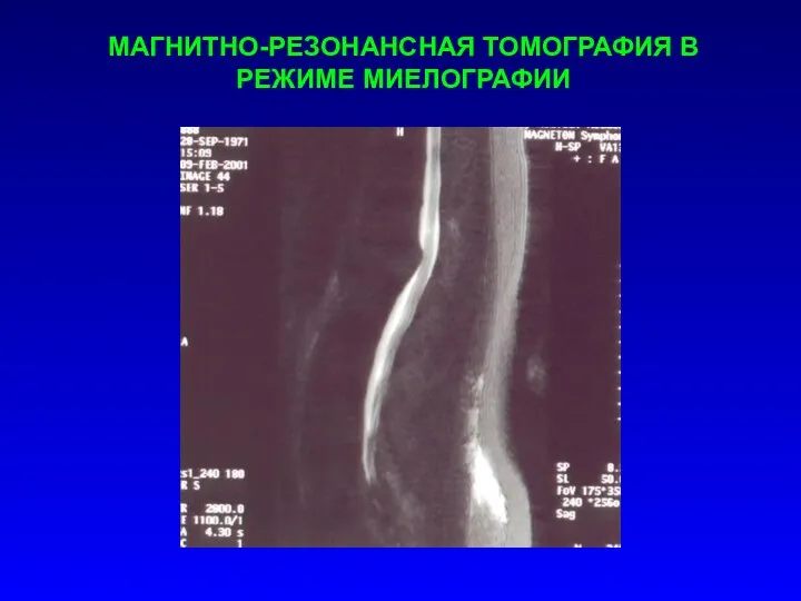 МАГНИТНО-РЕЗОНАНСНАЯ ТОМОГРАФИЯ В РЕЖИМЕ МИЕЛОГРАФИИ