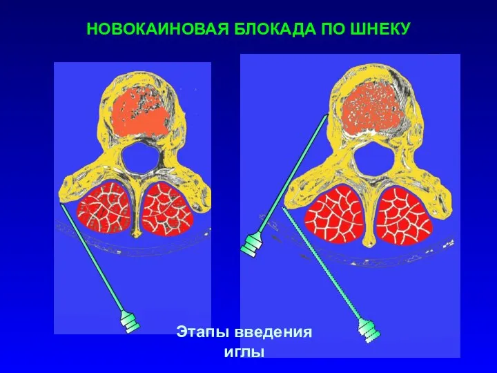 НОВОКАИНОВАЯ БЛОКАДА ПО ШНЕКУ Этапы введения иглы