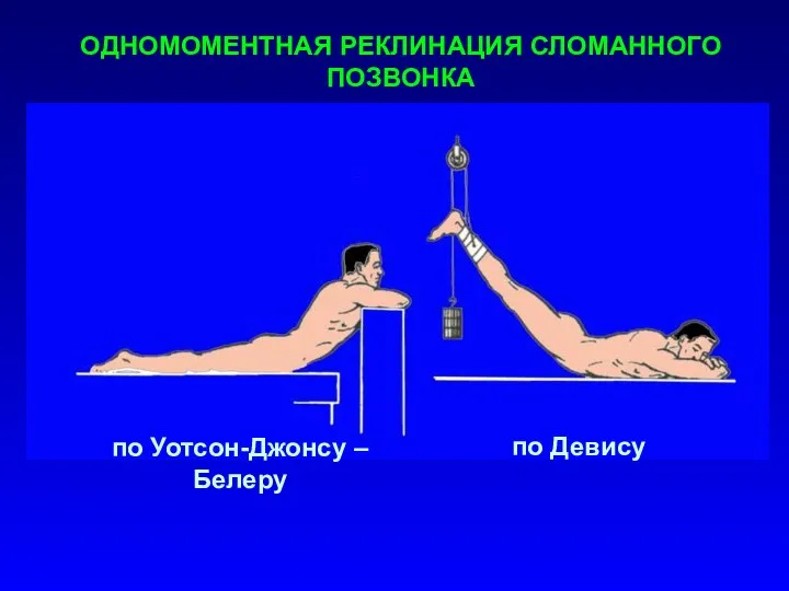 ОДНОМОМЕНТНАЯ РЕКЛИНАЦИЯ СЛОМАННОГО ПОЗВОНКА по Уотсон-Джонсу – Белеру по Девису