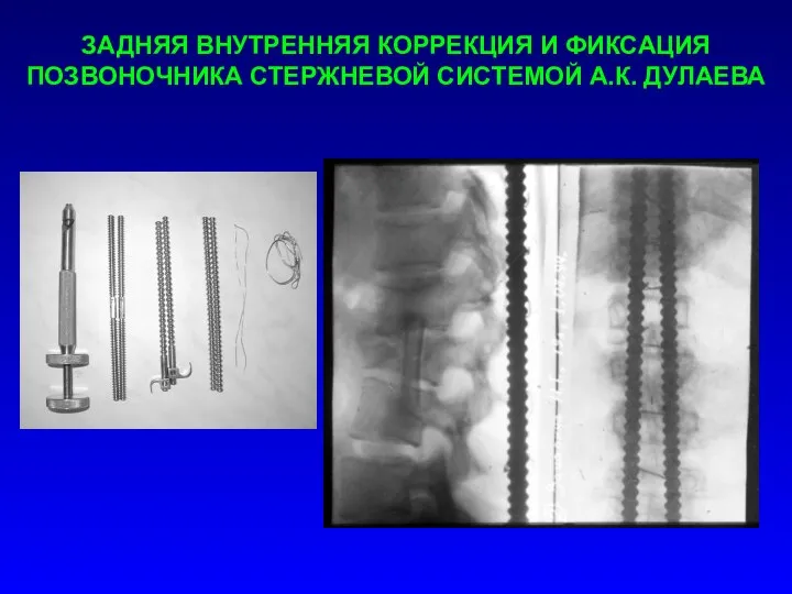 ЗАДНЯЯ ВНУТРЕННЯЯ КОРРЕКЦИЯ И ФИКСАЦИЯ ПОЗВОНОЧНИКА СТЕРЖНЕВОЙ СИСТЕМОЙ А.К. ДУЛАЕВА