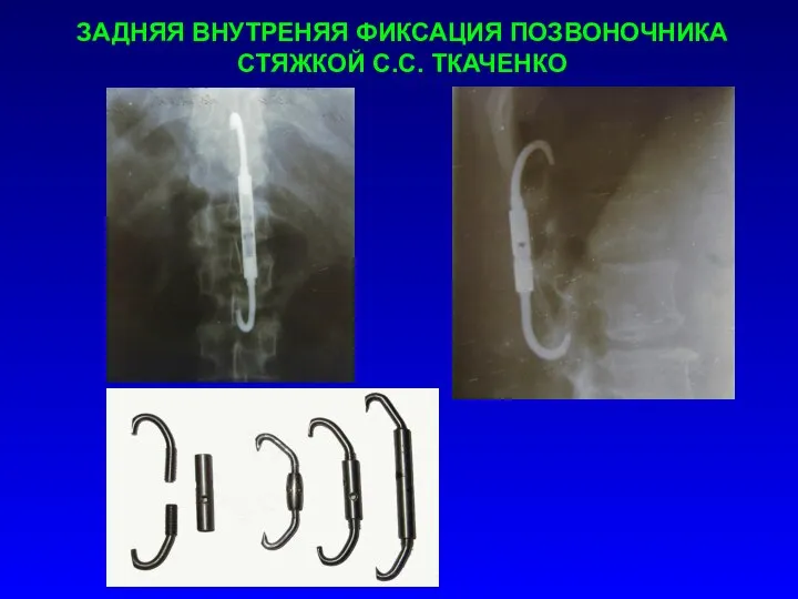 ЗАДНЯЯ ВНУТРЕНЯЯ ФИКСАЦИЯ ПОЗВОНОЧНИКА СТЯЖКОЙ С.С. ТКАЧЕНКО