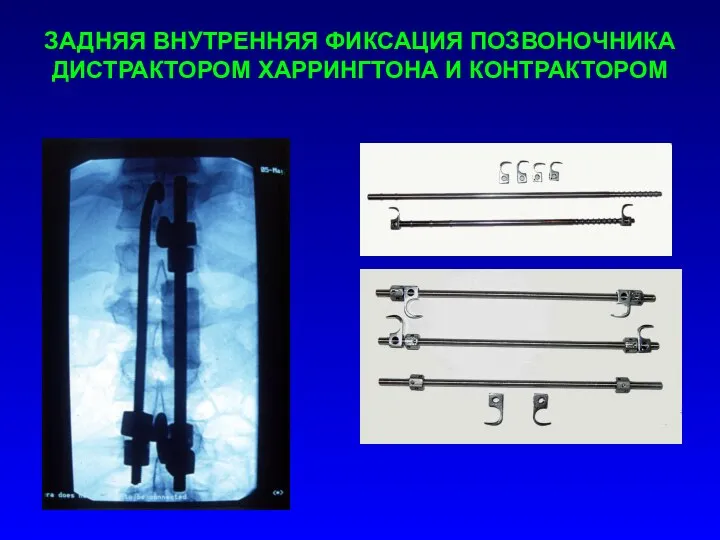 ЗАДНЯЯ ВНУТРЕННЯЯ ФИКСАЦИЯ ПОЗВОНОЧНИКА ДИСТРАКТОРОМ ХАРРИНГТОНА И КОНТРАКТОРОМ