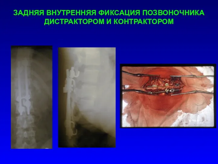 ЗАДНЯЯ ВНУТРЕННЯЯ ФИКСАЦИЯ ПОЗВОНОЧНИКА ДИСТРАКТОРОМ И КОНТРАКТОРОМ