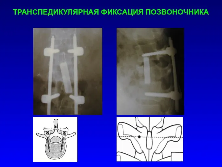 ТРАНСПЕДИКУЛЯРНАЯ ФИКСАЦИЯ ПОЗВОНОЧНИКА