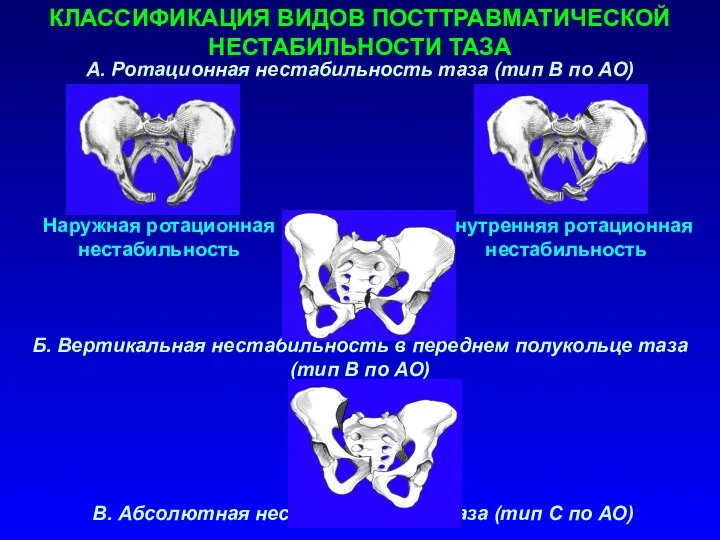 А. Ротационная нестабильность таза (тип В по АО) Наружная ротационная нестабильность