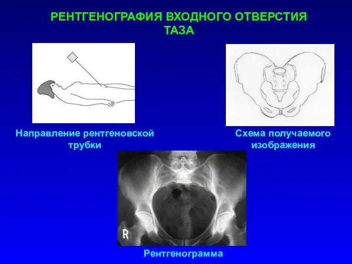 Направление рентгеновской трубки Схема получаемого изображения Рентгенограмма РЕНТГЕНОГРАФИЯ ВХОДНОГО ОТВЕРСТИЯ ТАЗА